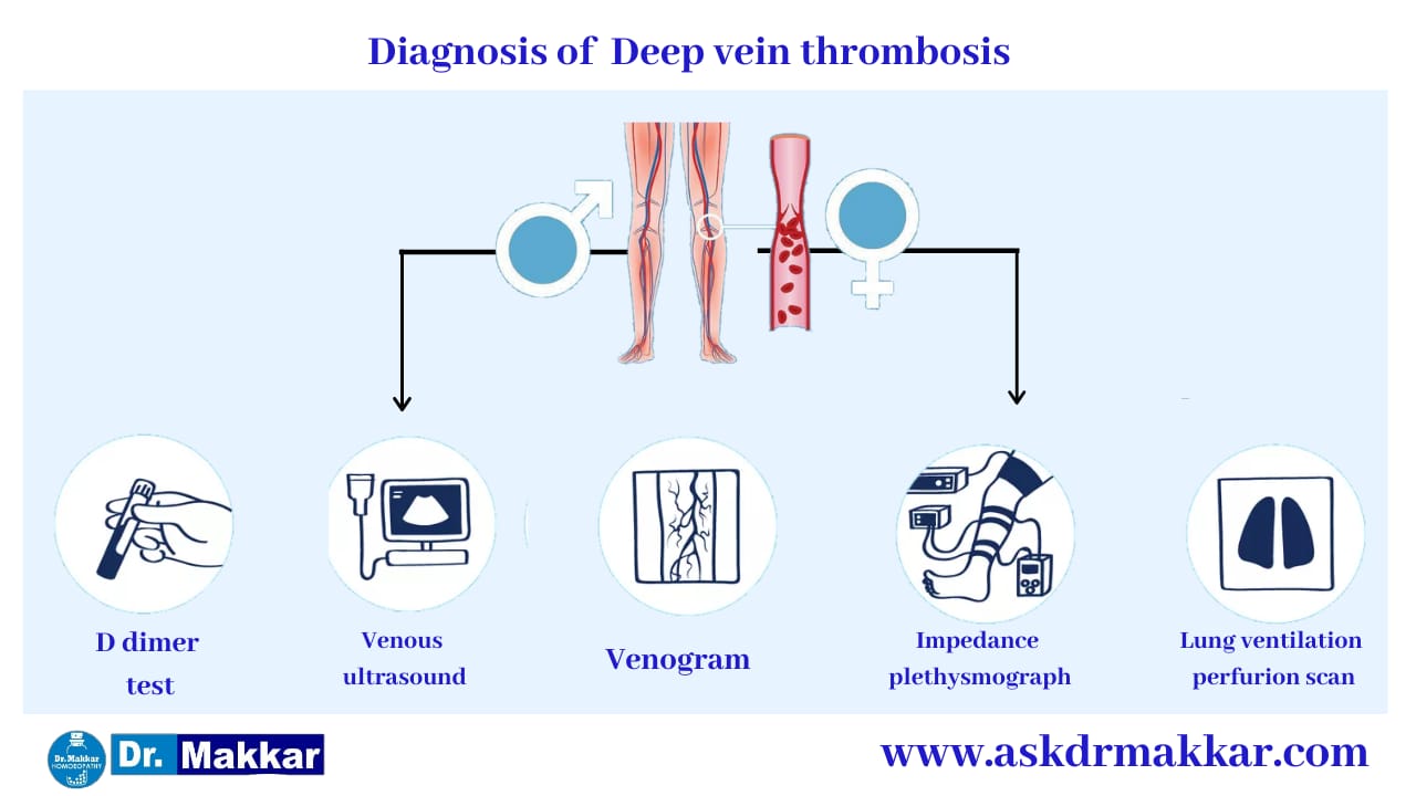 Diagnosis and investigations for Deep Vein Thrombosis DVT || डीप वेन थ्राम्बोसिस डीवीटी की मूल्यांकन  जाँच पड़ताल