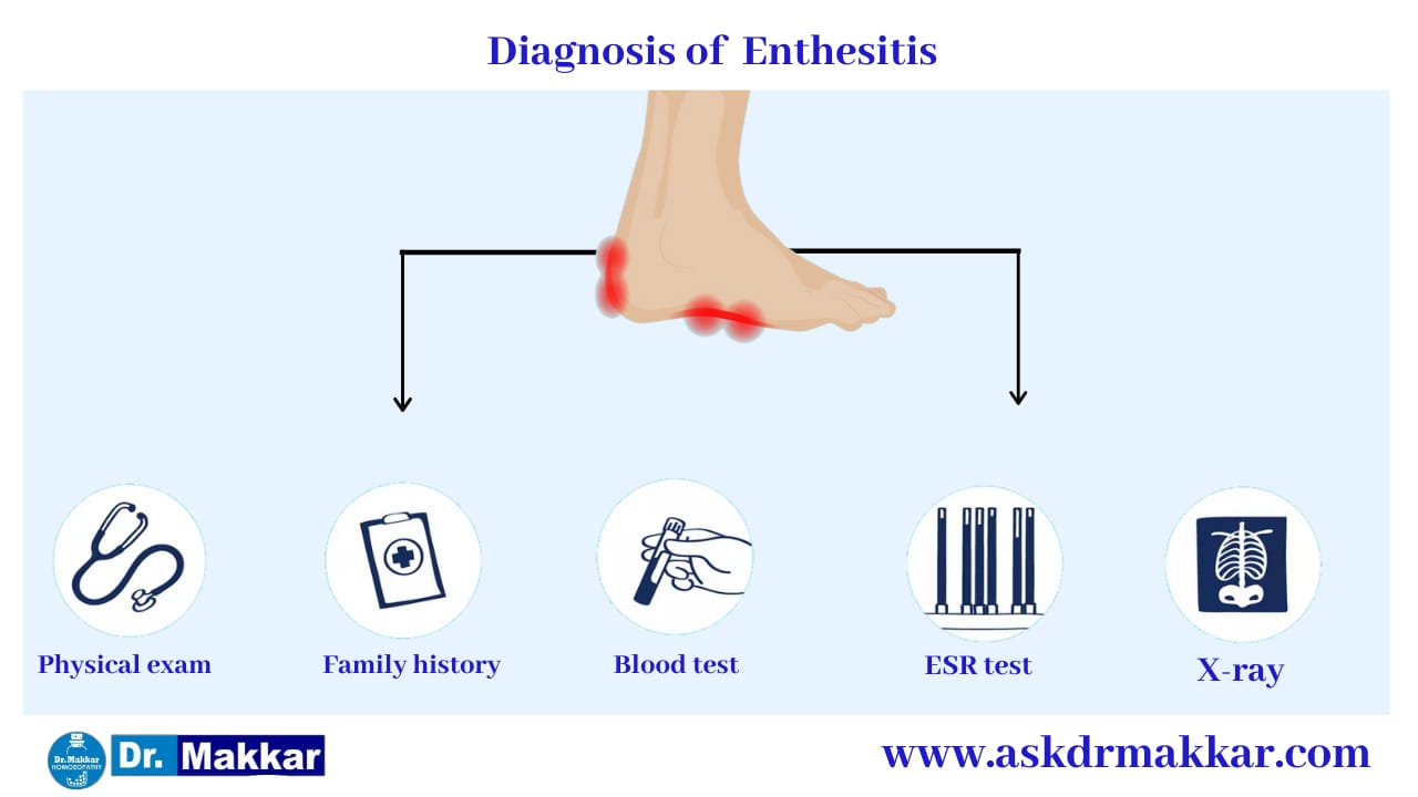 Diagnosis and investigations for Enthesitis SpondyloArthritis || एंथेसिसिटिस स्पोंडिलोआर्थराइटिस की मूल्यांकन  जाँच पड़ताल