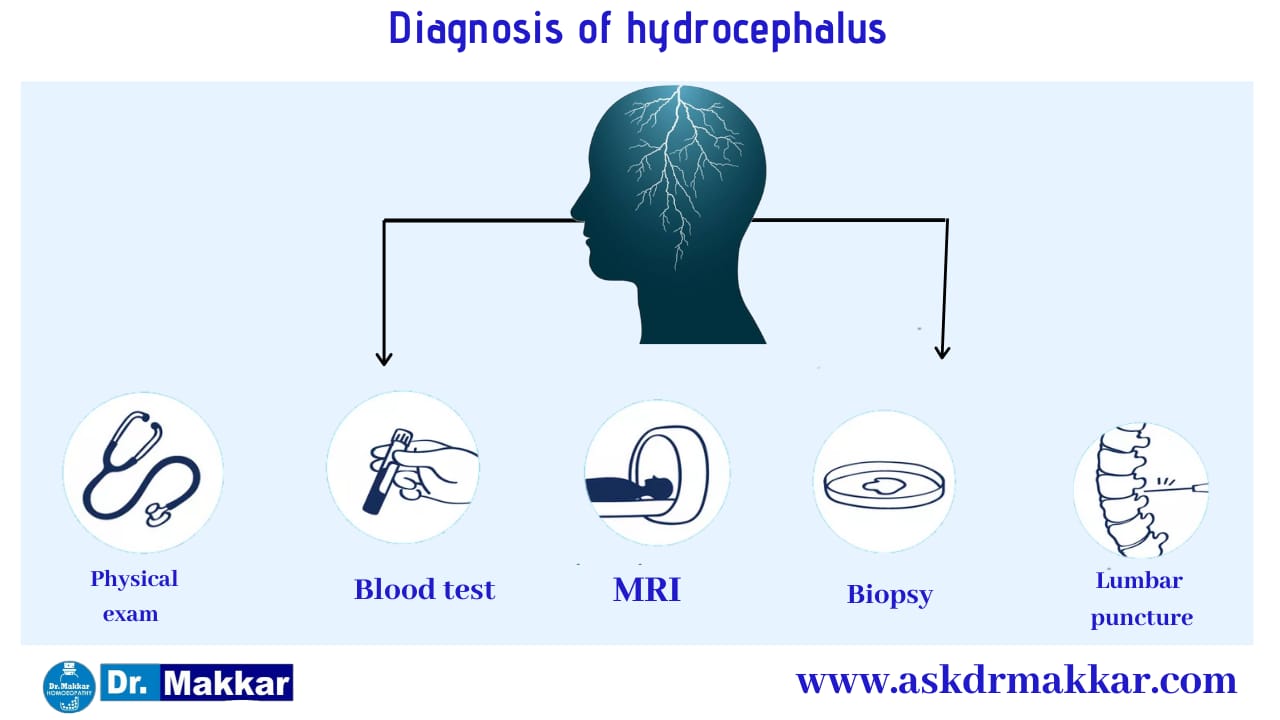 Diagnosis and investigations for Hydrocephalus || जलशीर्ष हाइड्रोसेफ़लस की मूल्यांकन  जाँच पड़ताल