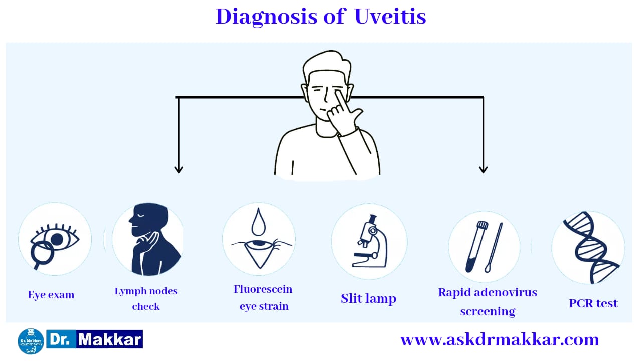 Diagnosis and investigations for Iritis Anterior Uveitis || "एंटीरियर यूवाइटिस" या इरिडोसाइक्लाइटिस की मूल्यांकन  जाँच पड़ताल