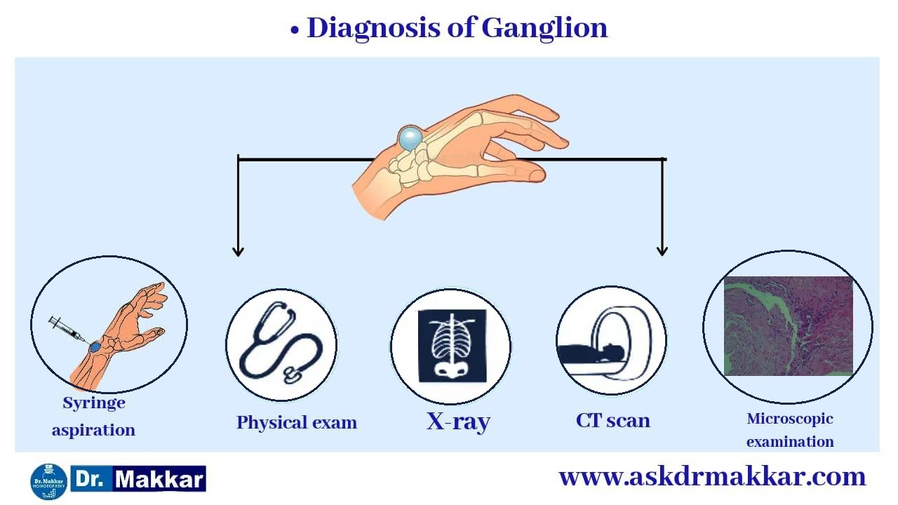 Diagnosis and investigations for ganglion || नाड़ीग्रन्थि गांठ गांठ की मूल्यांकन  जाँच पड़ताल