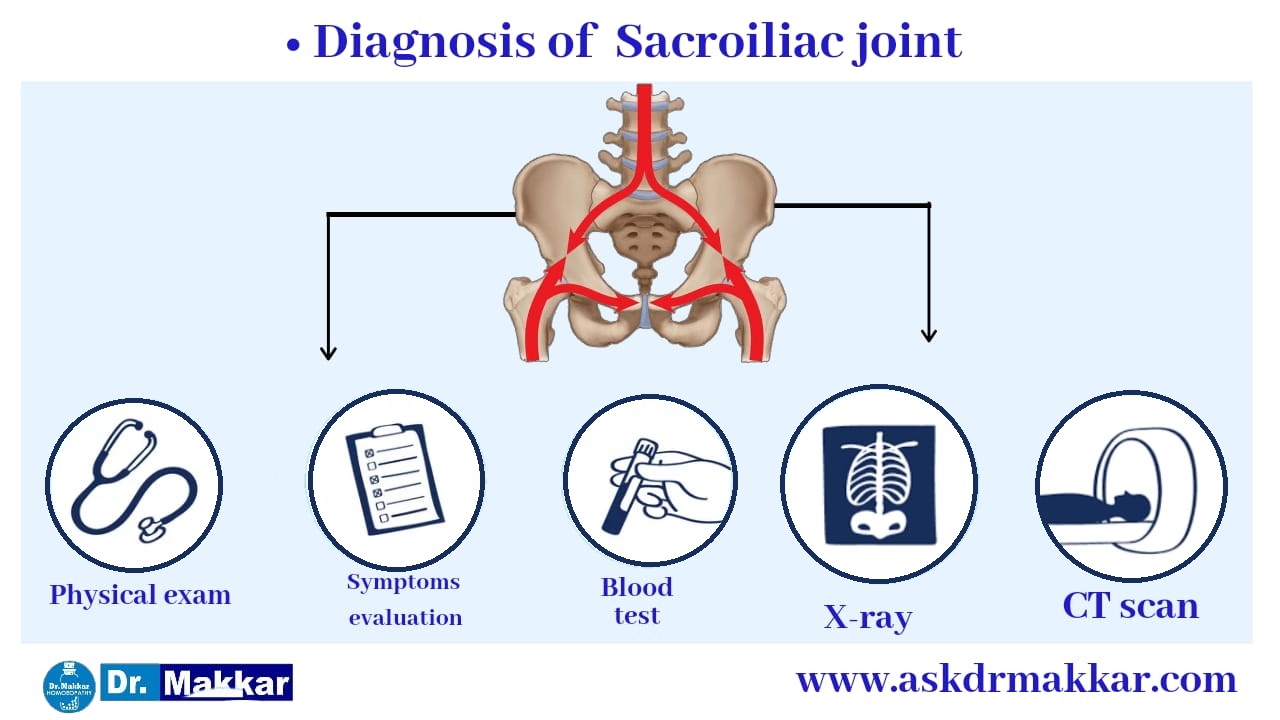 Diagnosis for  Sacroiliac Joint Dysfunction SI Joint Pain || सैक्रोइलियक संयुक्त रोग जोड़ों का दर्द का निदान