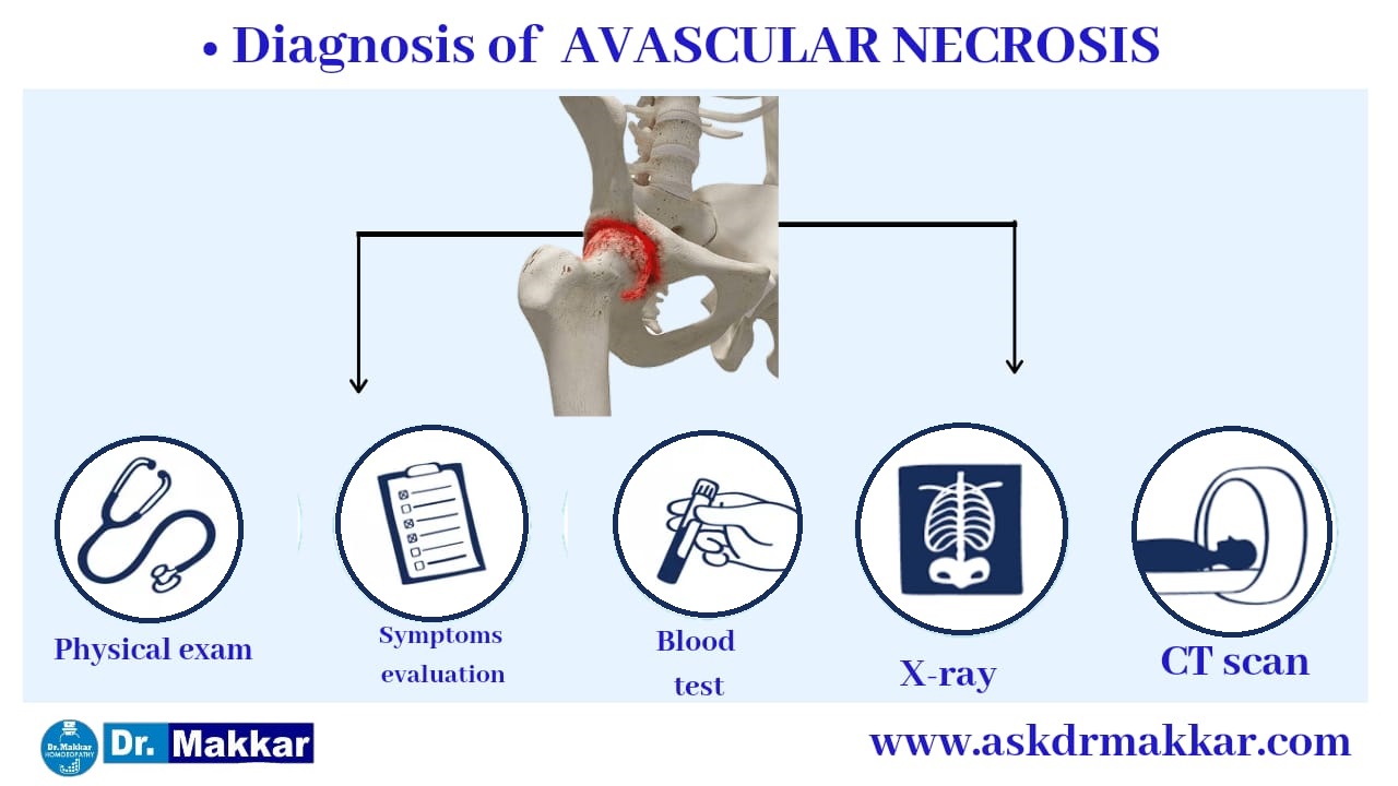 Diagnosis for Avascular Ischemic Necrosis AVN Osteonecrosis femur || एवस्कुलर इस्केमिक नेक्रोसिस एवीएन ओस्टियोनेक्रोसिस फीमर हड्डी का निदान