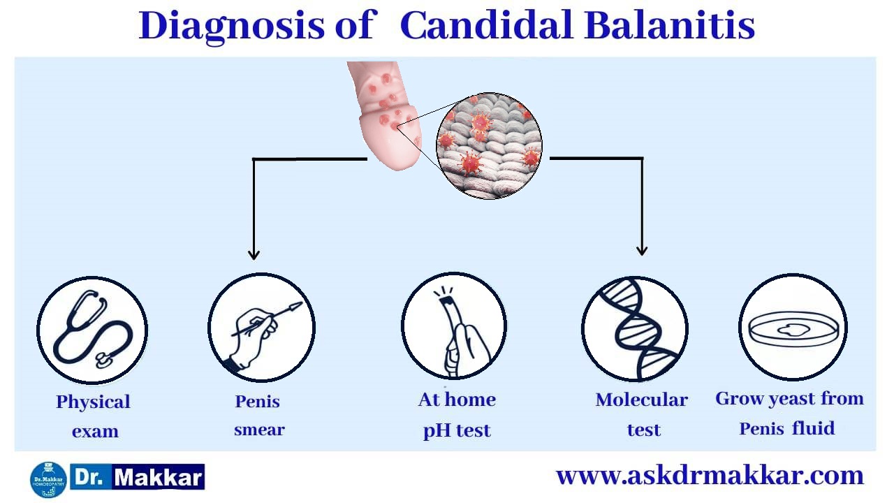 Diagnosis for Balanitis || बैलेनाइटिस रोग का निदान