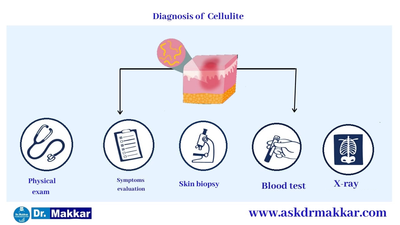 Diagnosis for Cellulitis Skin Infection || सेल्यूलाइटिस स्किन इंफेक्शन का निदान