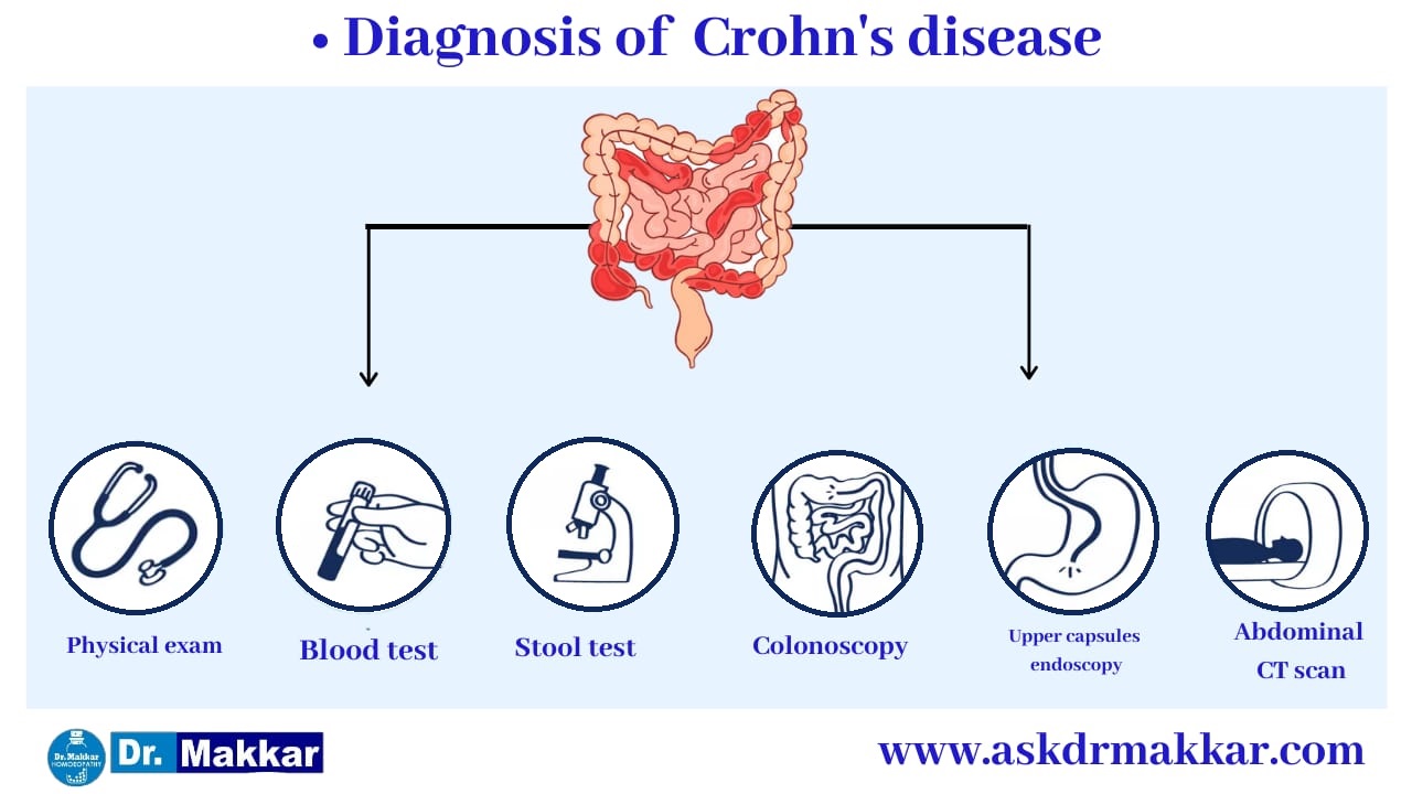 Diagnosis for Crohns Disease Inflammation of intestine || आंतों में सूजन  क्रोहन रोग का निदान