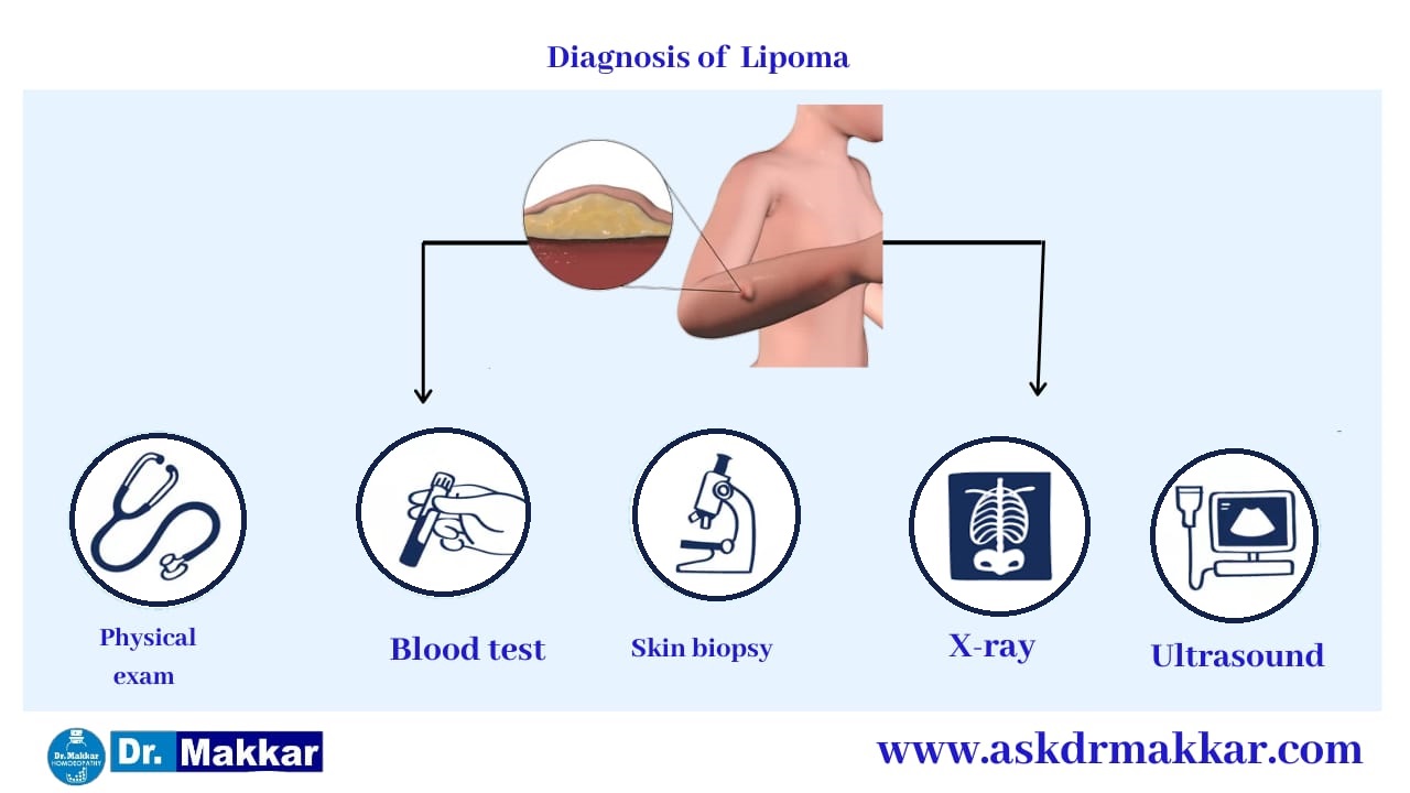 Diagnosis for Lipoma Benign Tumour under skin || चर्बी की गांठ लिपोमा का निदान