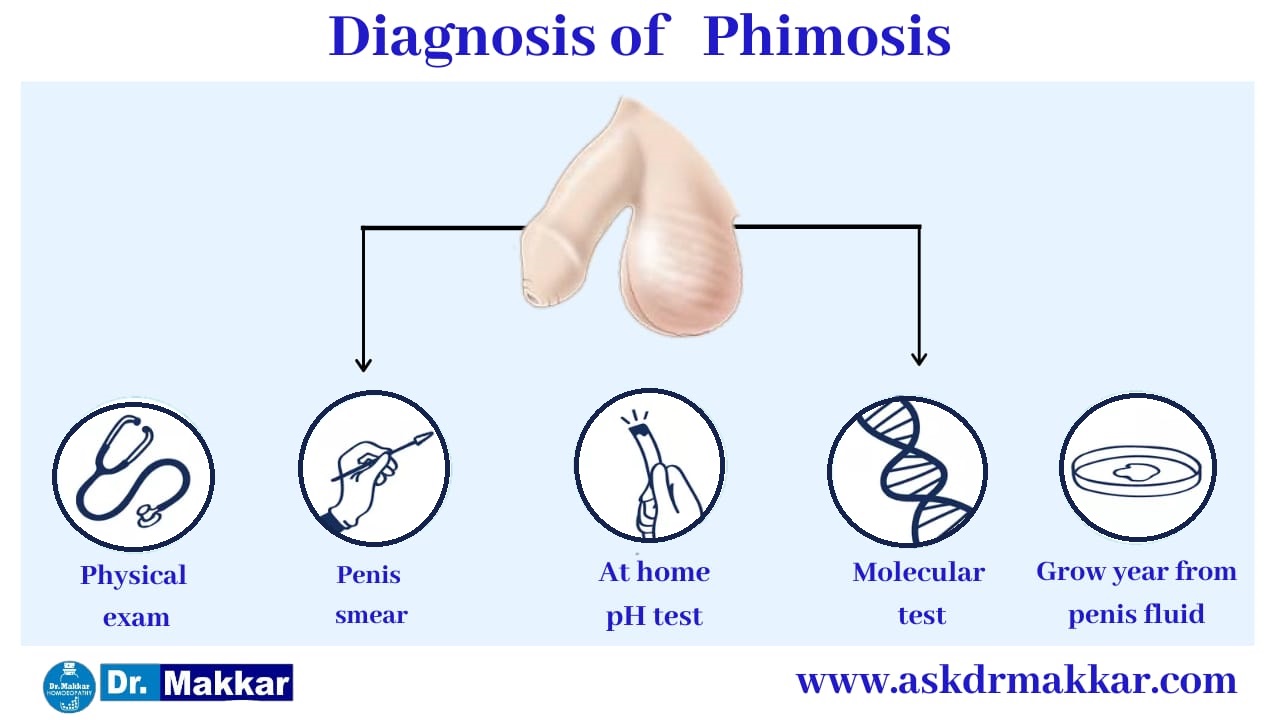 Diagnosis for Phimosis || फाइमोसिस या निरुद्धप्रकाश शिश्न योनि में खुजली जलन संक्रमण तरुण योनि शोथ का निदान