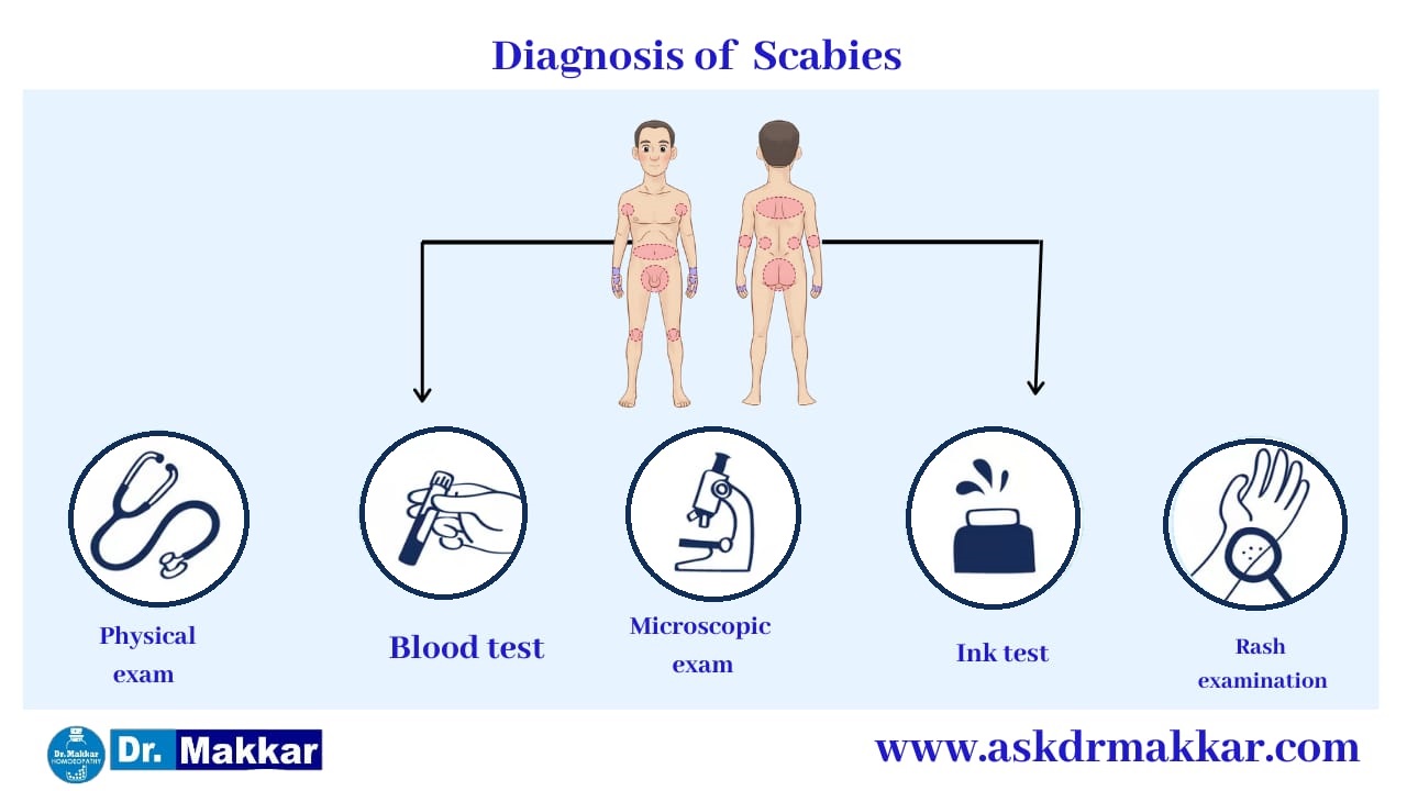 Diagnosis for Scabies || स्केबीज या खाज का निदान