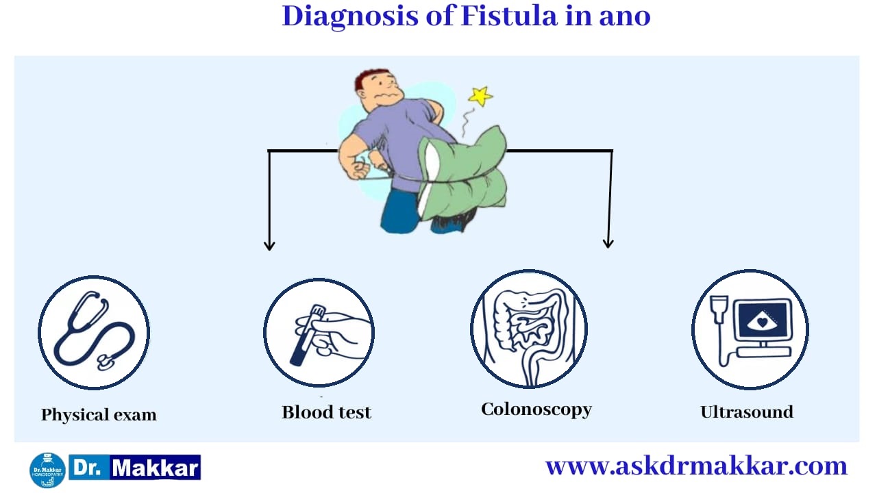 Diagnosis of FIstula in ano  || भगन्दर एनल फिस्टुला के मापदंड