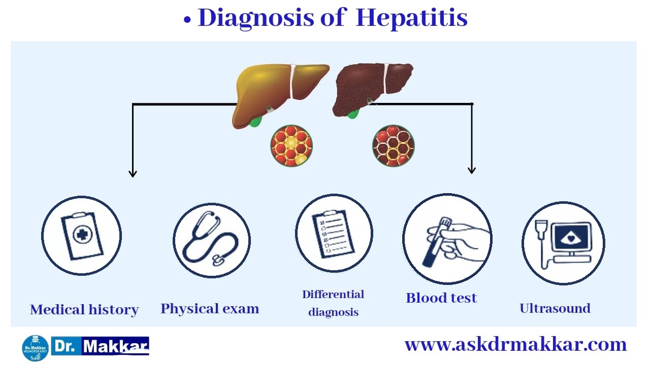 Diagnosis for Hepatitis B HBV || यकृतशोथ ख (हेपाटाइटिस बी) हेपाटाइटिस बी वायरस (HBV)  रोग का निदान