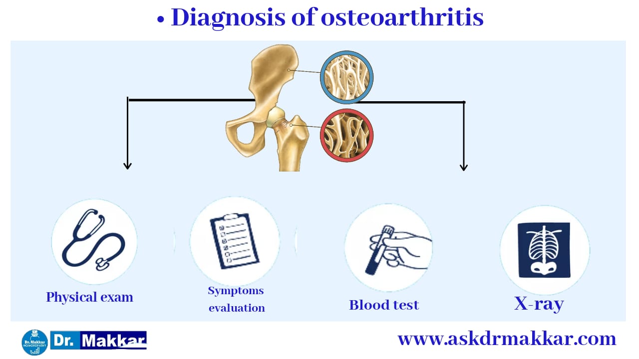 Diagnosis of Osteoarthritis