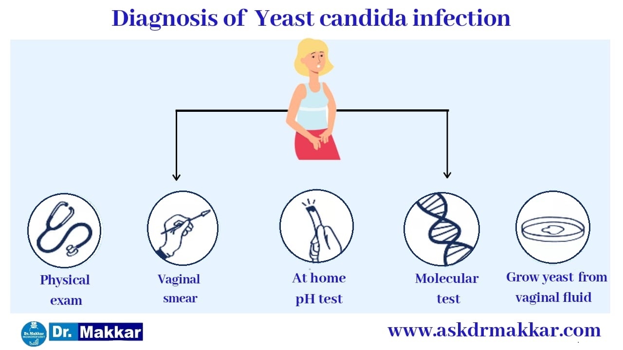 Diagnosis of Yeast Candida Infection ||  महिलाओं की योनि में खुजली या जलन वेजाइनल कैंडिडियासिस योनि  संक्रमण तरुण योनि शोथ मानदंड का निदान करना