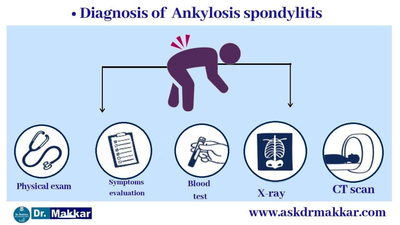 Diagnosis of ankylosing Spondolysis,xray,Mri,ct scan,blood reports,esr,uric acid 