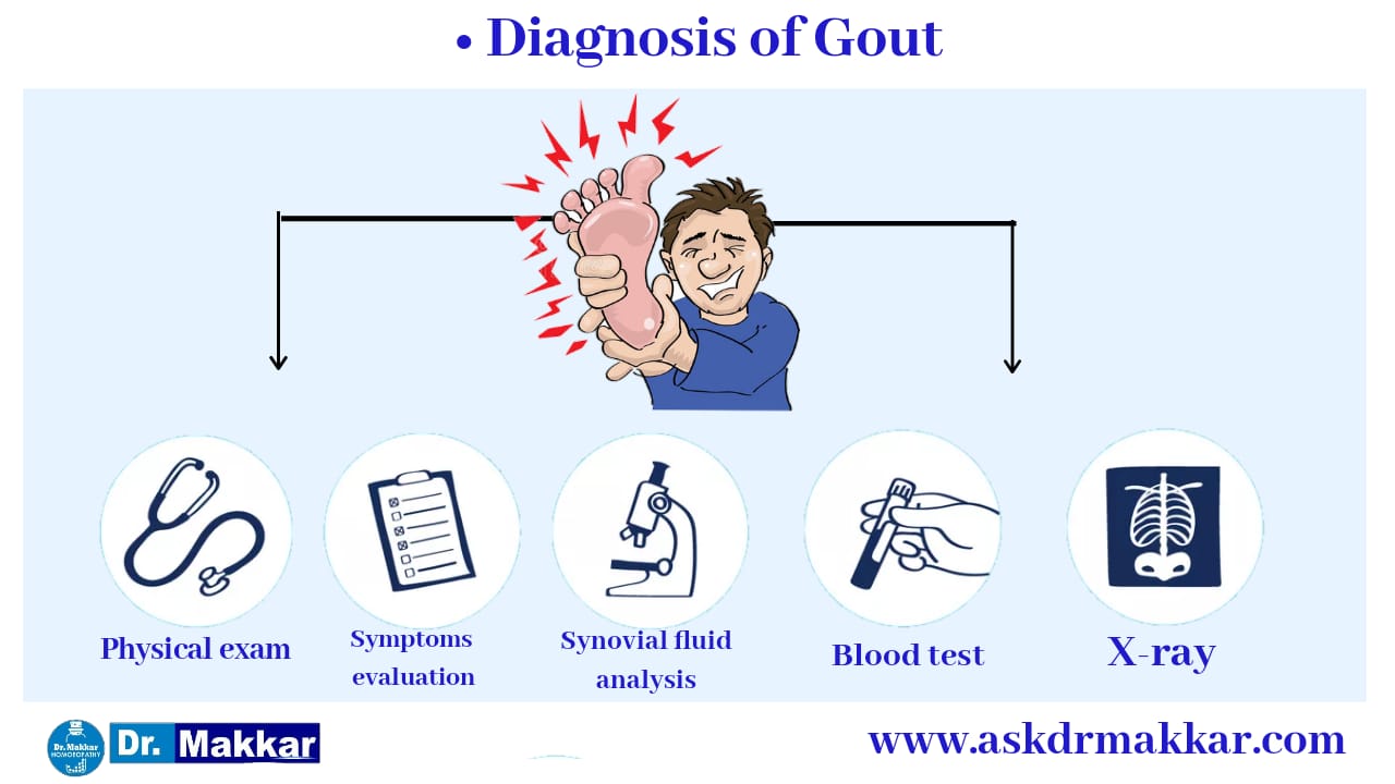 Diagnosis of gout Uric acid