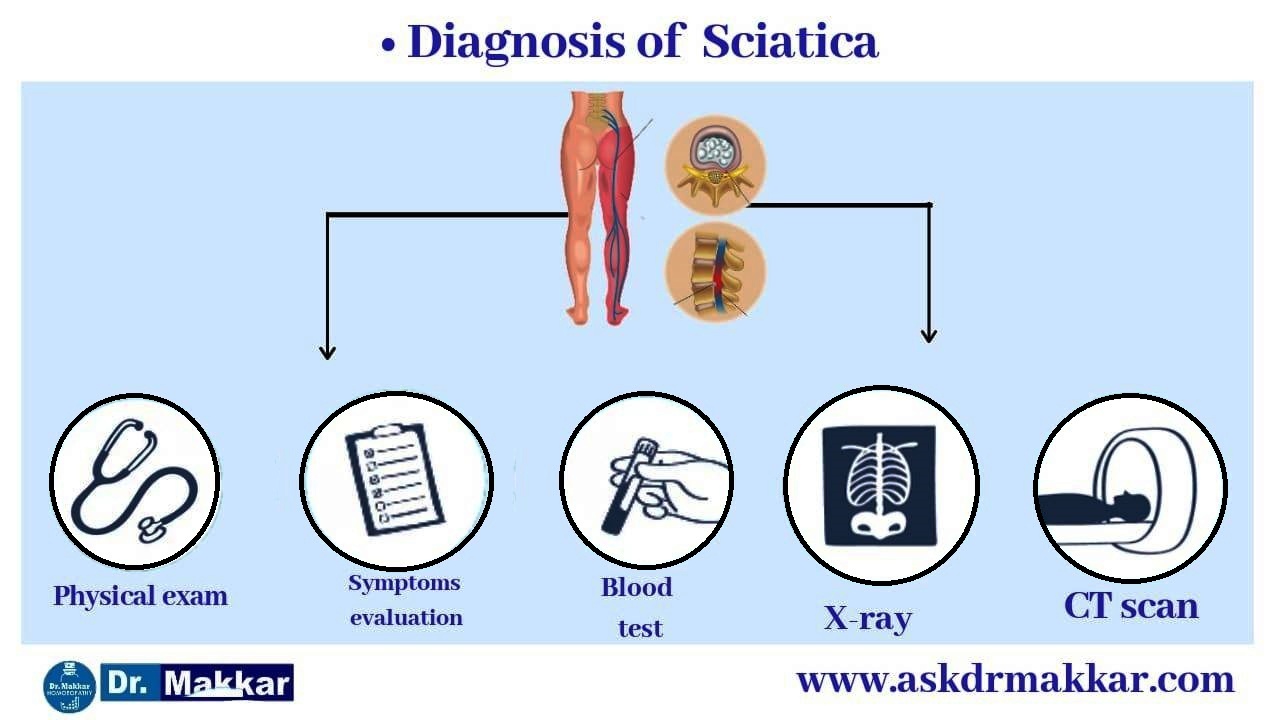 Diagnosis of Sciatica lumber Rediculopathy Diagnosisof sciatica || साइटिका  कटिस्नायुशूल का निदान: