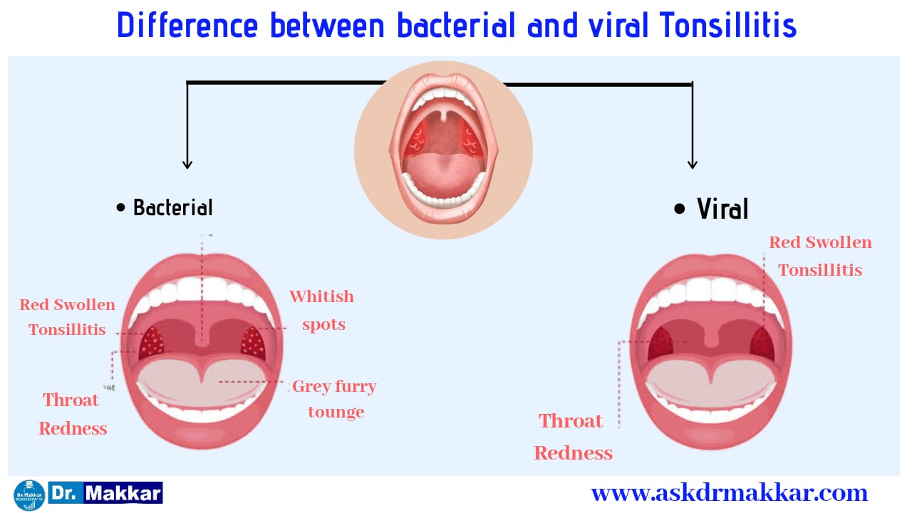 Difference between bacterial vs viral Tonsillitis