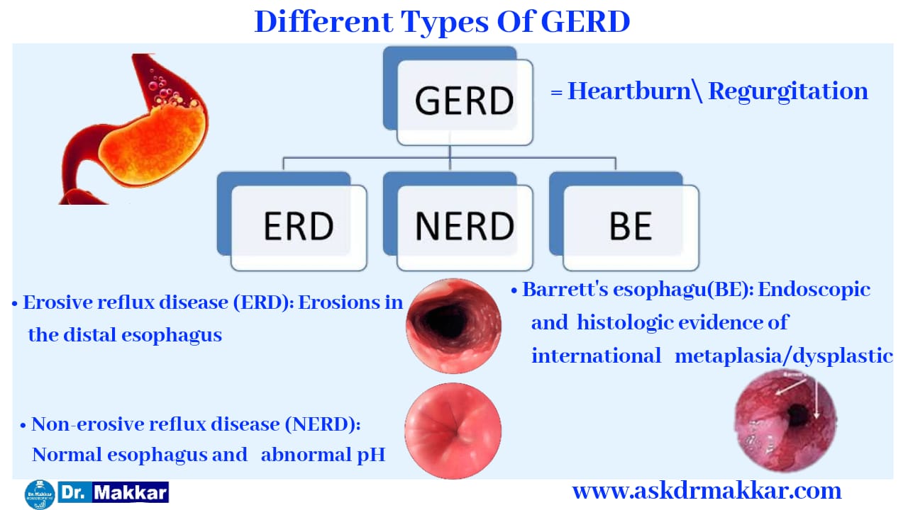Differnt type of Gerd Gastrooesophageal Reflux Disease ||  गेरड गैस्ट्रोसोफेजियल रिफ्लक्स डिजीज के डिफरेंट टाइप