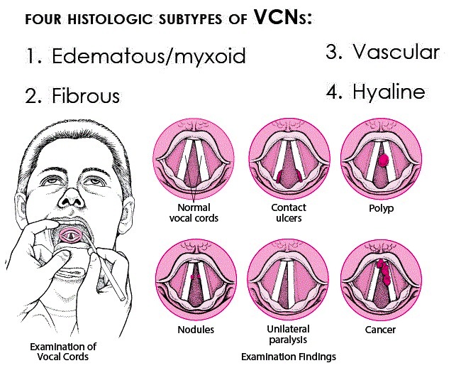 ENT laryngeal polyp leads different disorders|| ईएनटी लैरींगेपोलिप विभिन्न विकारों का नेतृत्व करता है स्वर ग्रंथि 