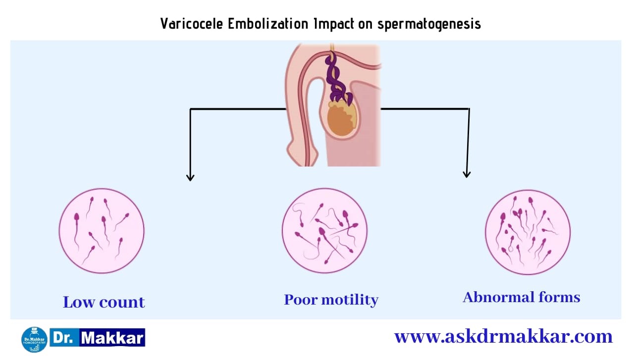 Effect of Varicocele on Spermatogenesis || शुक्राणुजनन पर वैरिकोसेले का प्रभाव