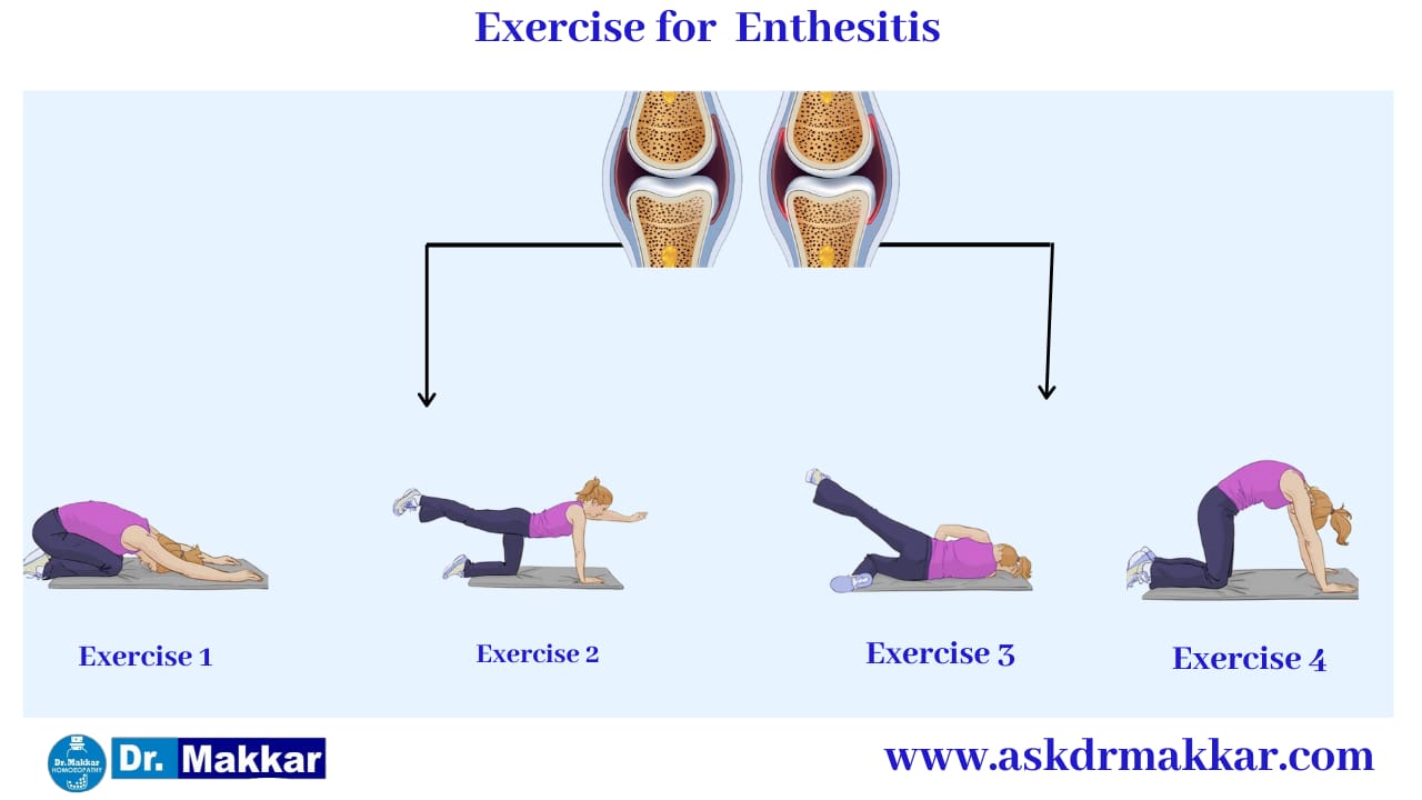Exercises as Self care measures exercises  Enthesitis SpondyloArthritis || एंथेसिसिटिस स्पोंडिलोआर्थराइटिस में सूजन 