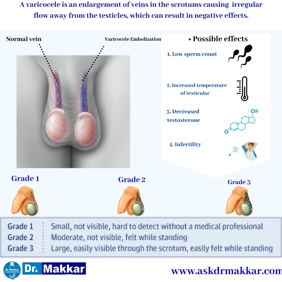 Grade Classification of Varicocele || वैरिकोसेले का ग्रेड वर्गीकरण