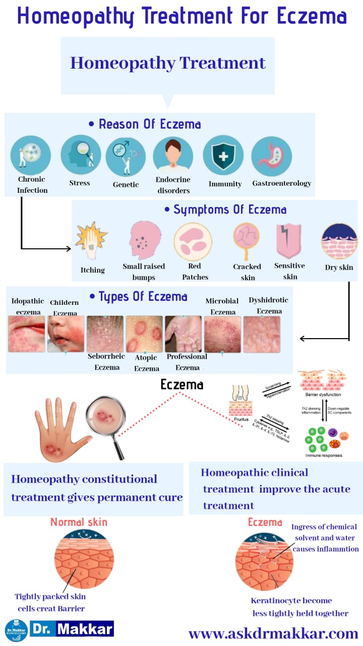 Homeopathic Treatment for Eczema