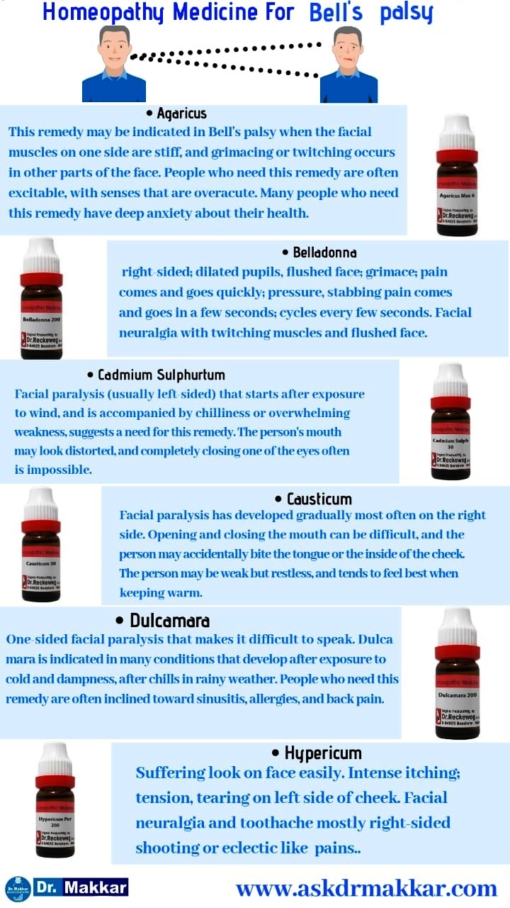 Homeopathic medicine for bells palsy 