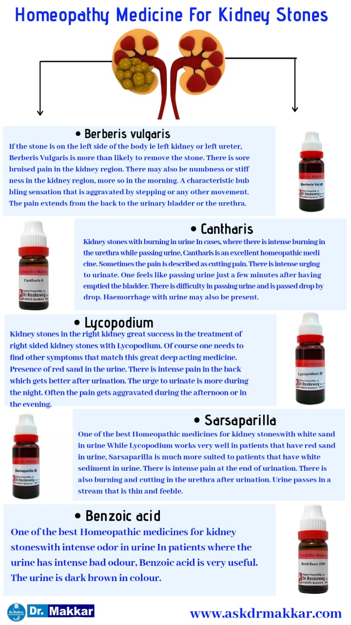Homeopathic medicine for kidney stones Urolithiasis renal calculi, nephrolithiasis