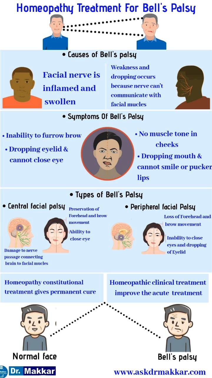 Homeopathic treatment for Bells Palsy Facial nerve disorder