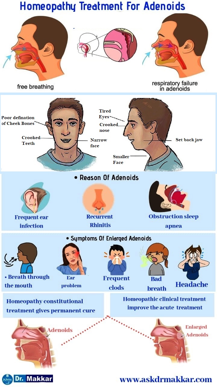 Homeopathic treatment for Adenoid Tumour nasal polyp explanation of adenoid facies