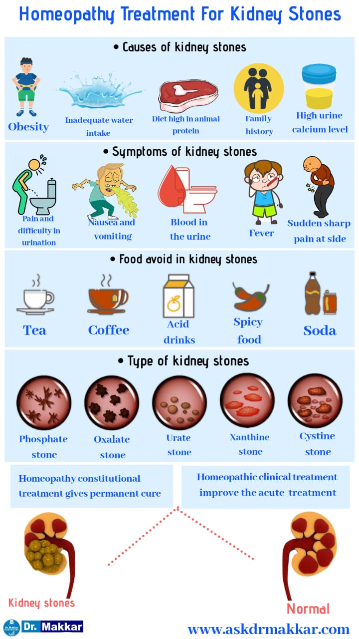 Homeopathic treatment for kidney stones Urolithiasis renal calculi, nephrolithiasis