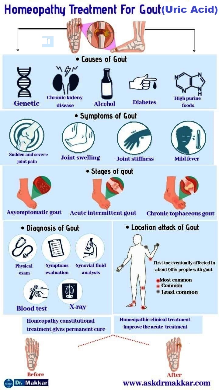 Homeopathic treatment of Gout  Uric acid India punjab