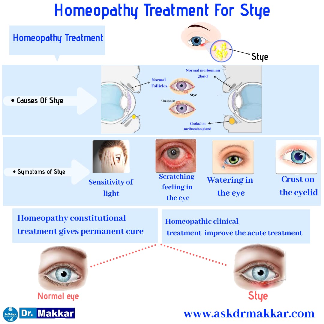 Homeopathic treatment of stye Chalazion