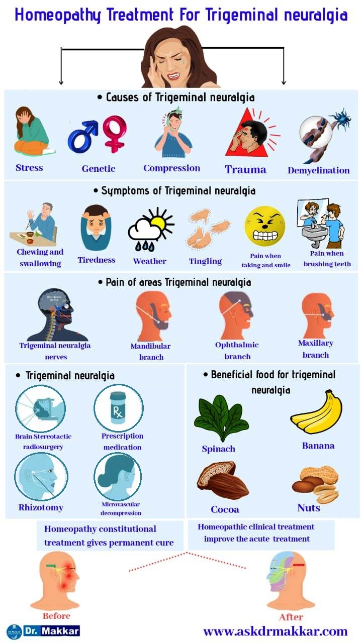 Best Homoeopathic Treatment Trigerminal Neuralgia