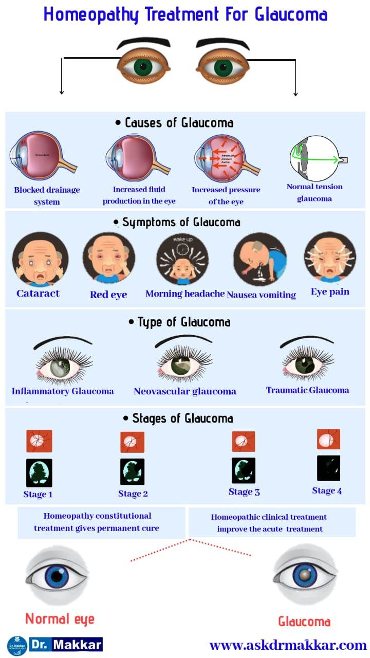Homoeopathic Treatment of Glaucoma  || ग्लूकोमा का होम्योपैथिक इलाज