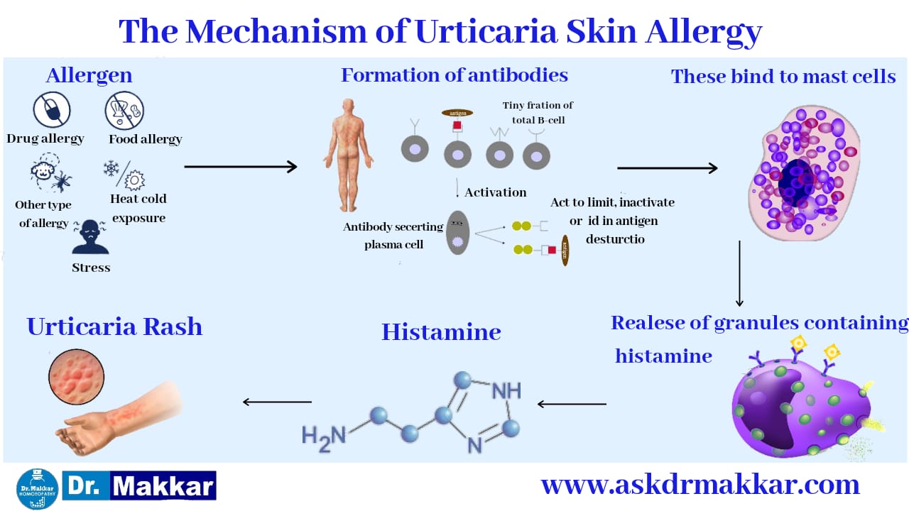 How Urticarial rash occur skin allergy