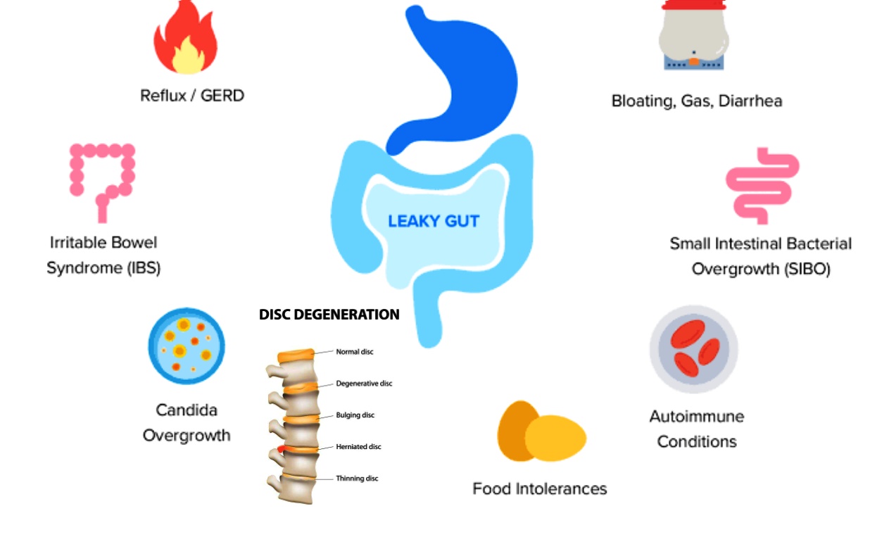 Irritable Bowel Syndrome, Crohn’s Disease and Ankylosing Spondylitis