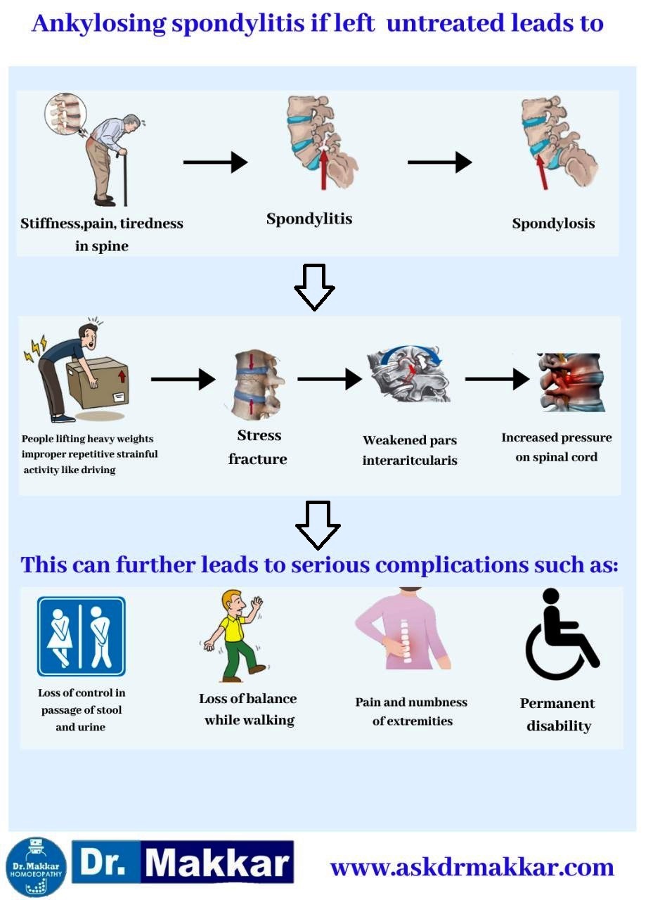 If Ankylosing Spondylosis untreated leads to stiffness leads to fibrosis lead to osteophyte formation & loss of urine stool