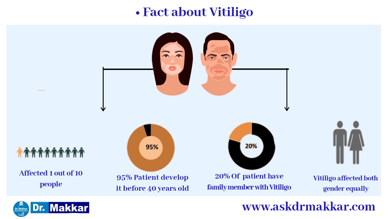 If you have a Leucoderma patient in your house learn statics