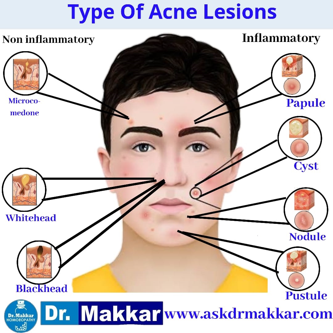 Types of acne inflammatory vs non inflammatory