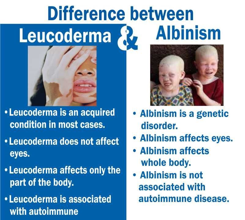 Leucoderma vs albinism