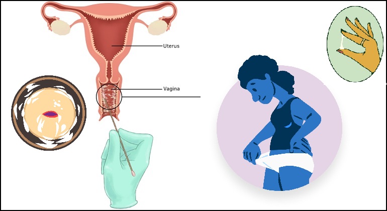 Leucorrhoea what does it means when Immediate medical attention needed required  ल्यूकोरिया का क्या मतलब है जब हमें तत्काल चिकित्सा की आवश्यकता होती है