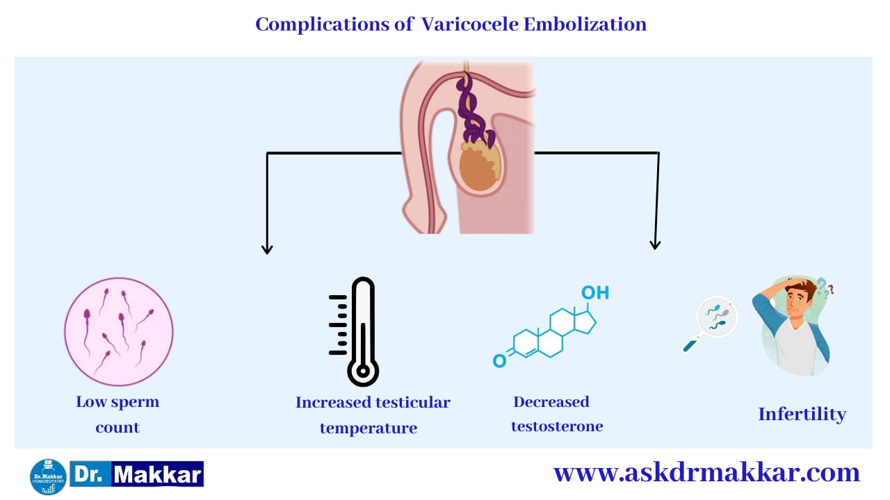 Long Term complication of varicocele || वैरिकोसेले की दीर्घकालिक जटिलता