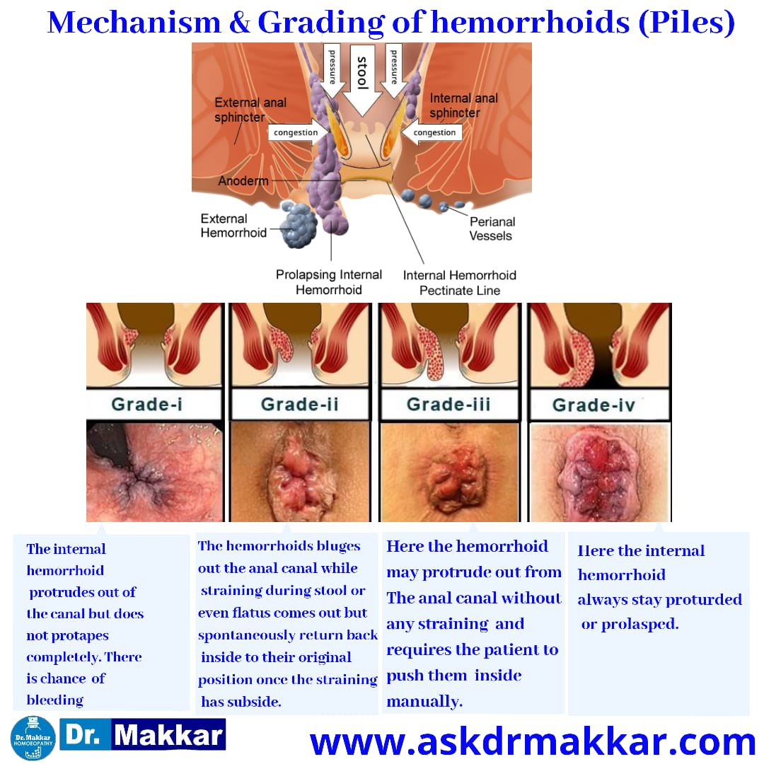 Mechanism & grading of piles haemorrhoids Piles or Hemorrhoids are broadly classified as following Grades || बवासीर या बवासीर को मोटे तौर पर विभिन्न निम्न ग्रेड के रूप में वर्गीकृत किया जाता है by homeopthic Dr Makkar