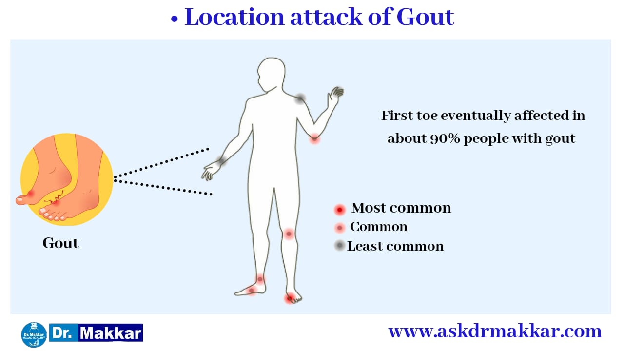 Parts of Body effected by Uric acid Gout