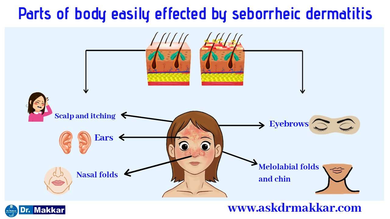 Parts of bdy affected by Seborrhic dermatitis