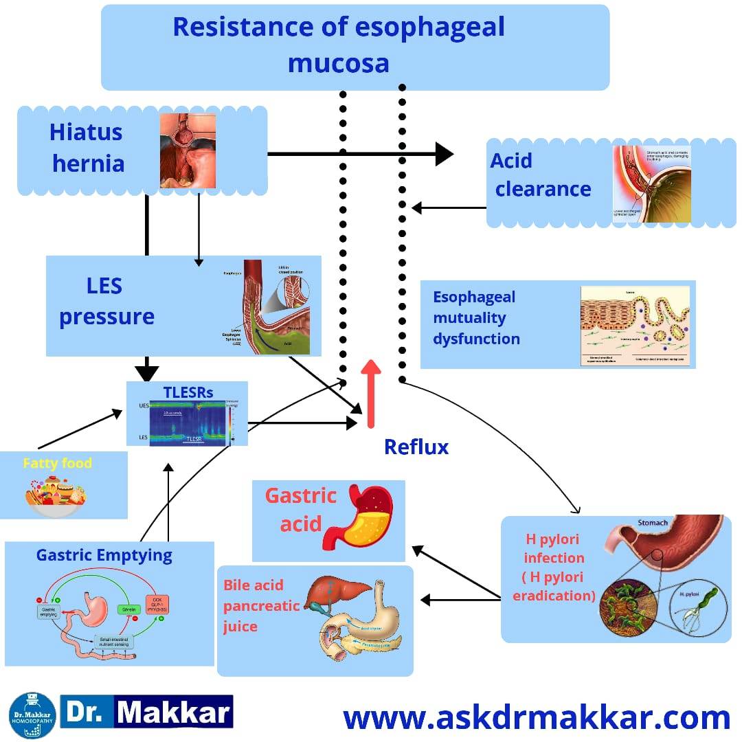 Pathogenesis of Gerd  Gastroesophageal Reflux Disease (GERD)