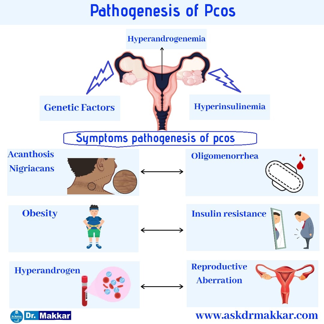 Pathogenesis of PCOS