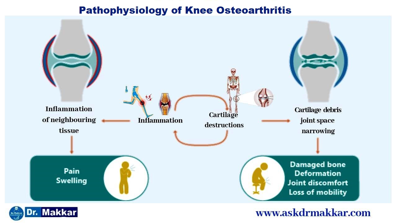 Pathophysiology of Osteoarthritis